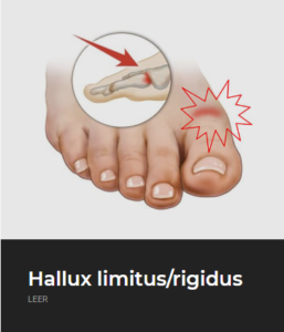 Hallux Limitu - ECiPP 