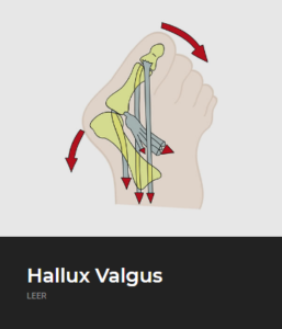 Hallux Valgus - ECiPP 