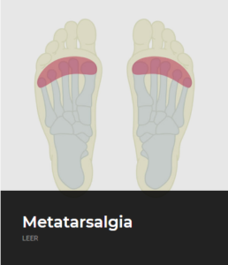 Metatarsalgia - ECiPP 