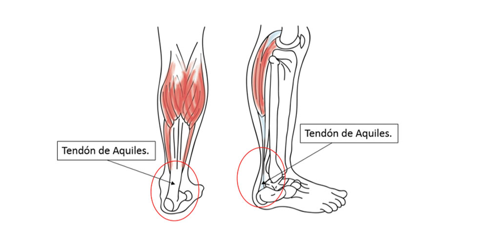 Rotura talon de aquiles - ECiPP