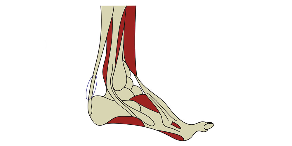 Rotura talon de aquiles - ECiPP
